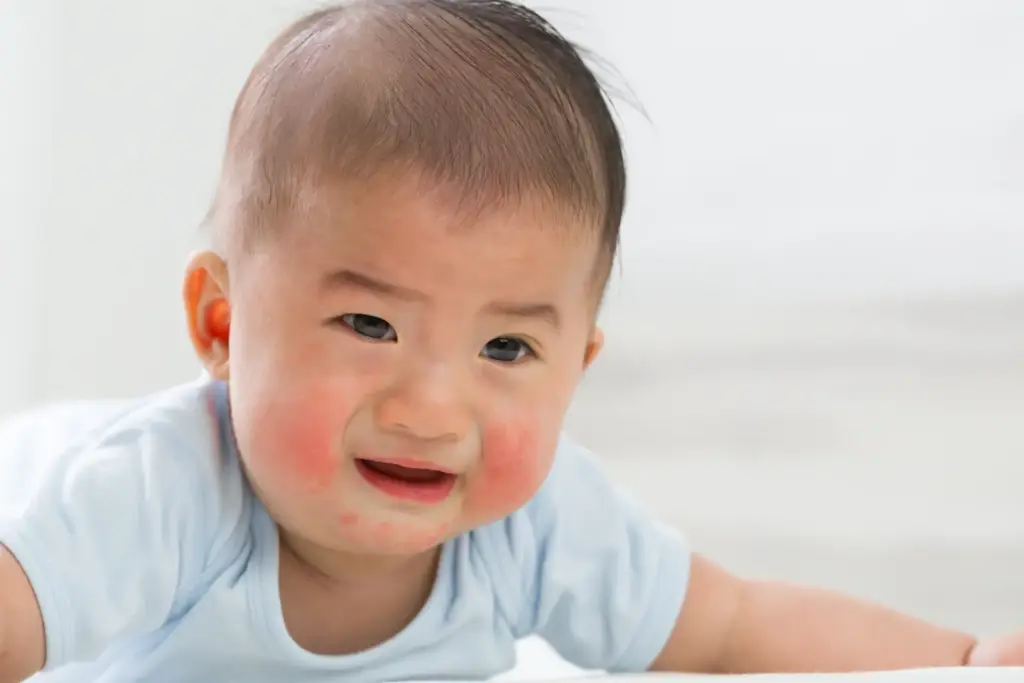 skin rashes babies concept 1